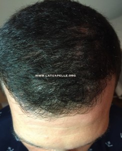 Intralesional steroid treatment alopecia areata