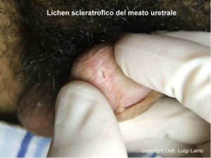 Lichen sclerosus meato uretrale