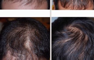 Stop alla Calvizie con la ricrescita naturale: Terapia rigenerativa HC