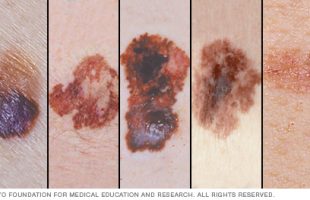 Ogni ora un paziente muore di Melanoma: 15 notizie da conoscere subito!