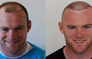 Trapianto Capelli: qual è il più indicato per me?