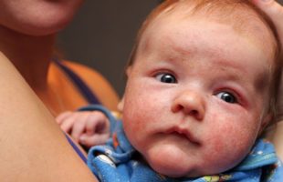 Scoperto il Ruolo del Microbioma intestinale nella Dermatite Atopica