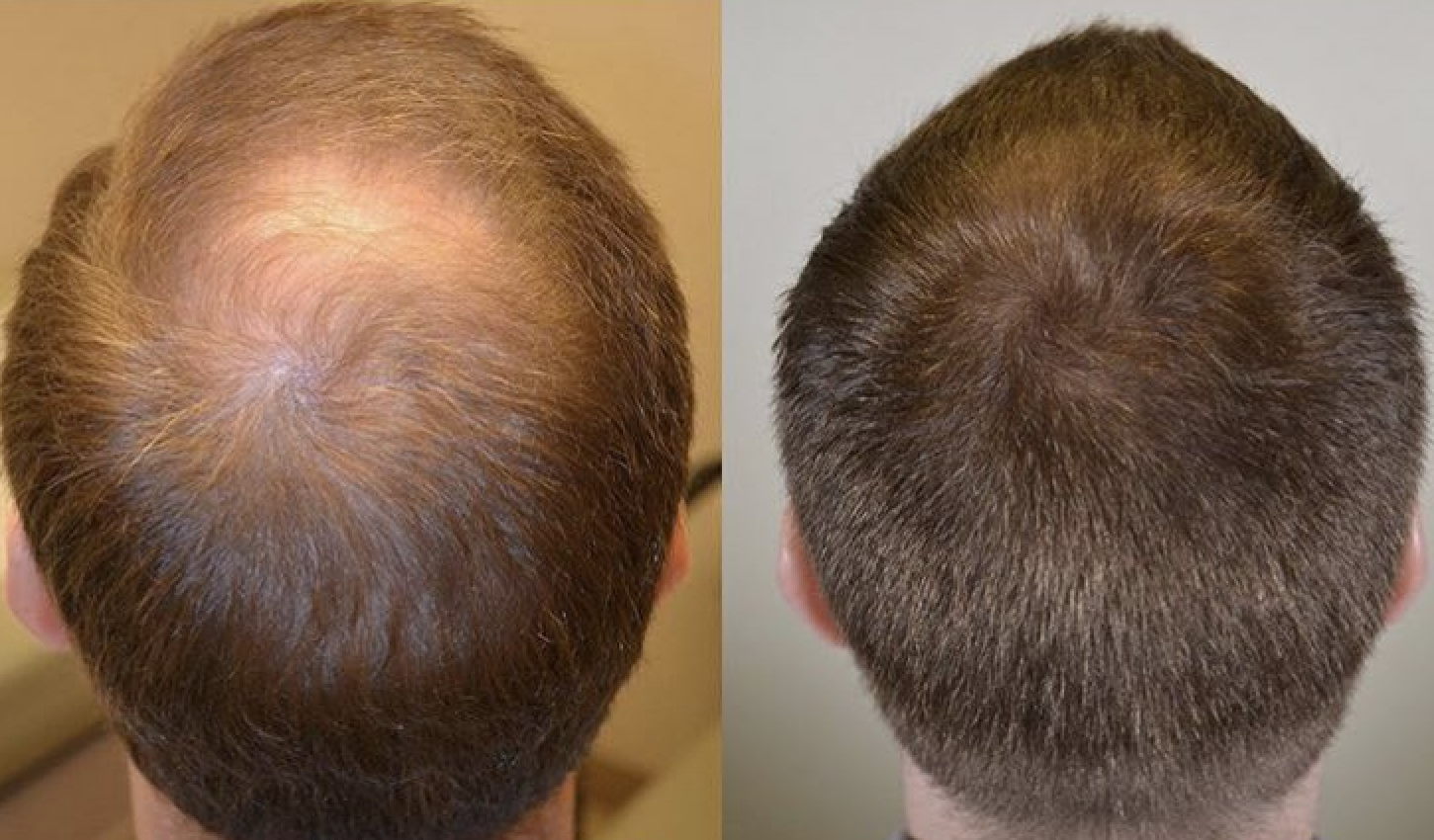 Результаты роста волос. Андрогенная алопеция миноксидил. Миноксидил для волос для мужчин. Миноксидил алерана эффект.